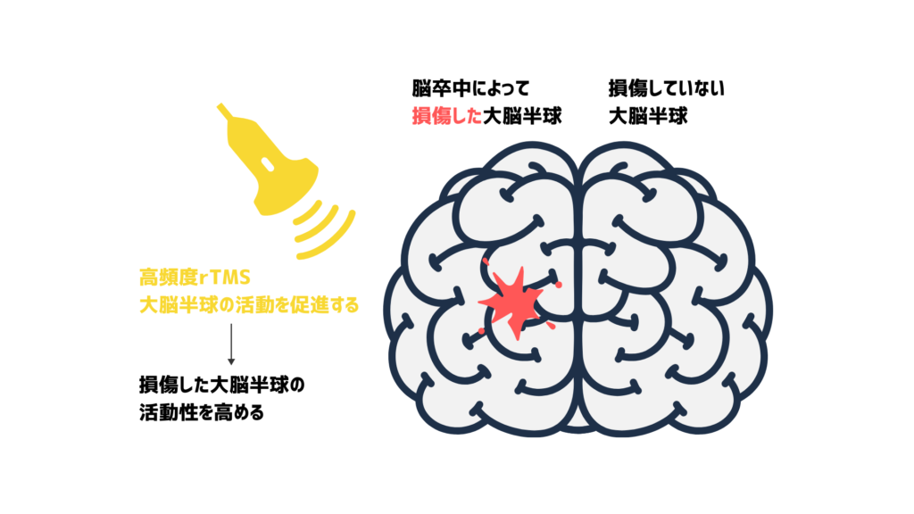 高頻度rTMSが損傷した大脳半球の活動を促進し、損傷した大脳半球の活動を高めている図