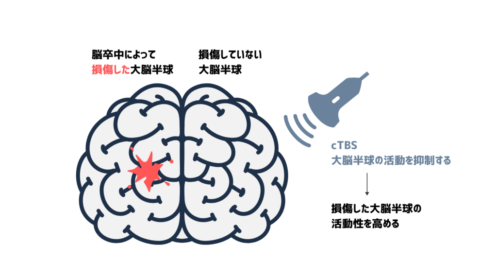cTBSが損傷していない大脳半球の活動を抑制し、損傷した大脳半球の活動を高めている図